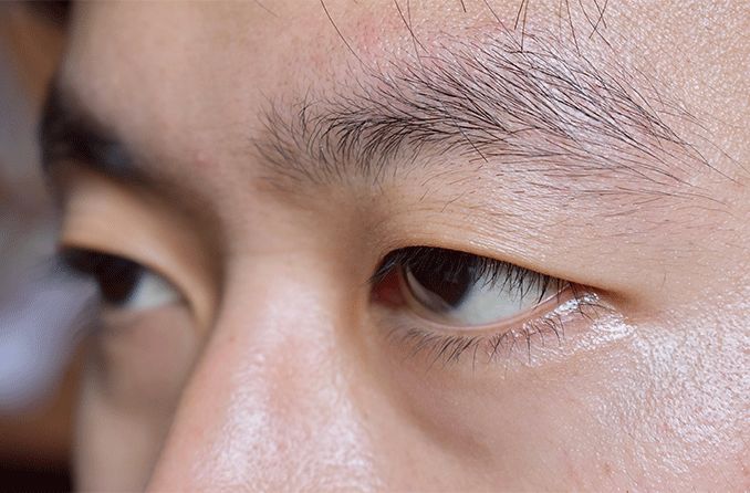 Things You Should Know About Double Eye Lids Conditions