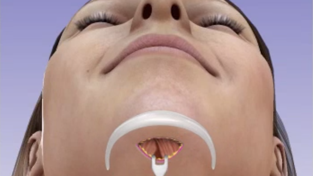 How Does Chin Plastic Surgery Work?