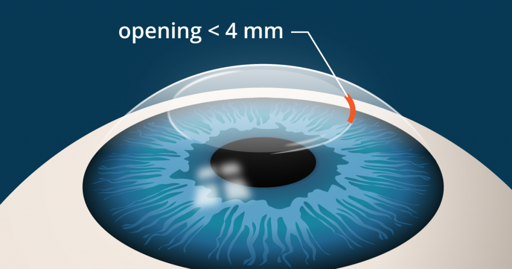 Difference Between PRK, Epi-LASIK, and SMILE in Eye Surgery