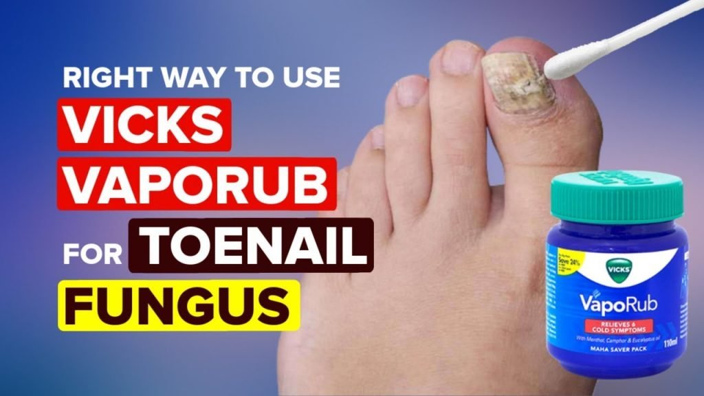 Can Vicks Get Rid of Toenail Fungus?