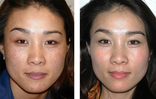 Pigmentation Removal Singapore: Your Guide to Fabulous Skin