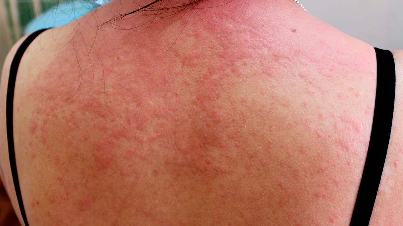 what-are-the-most-common-types-of-rashes-ur-health-info