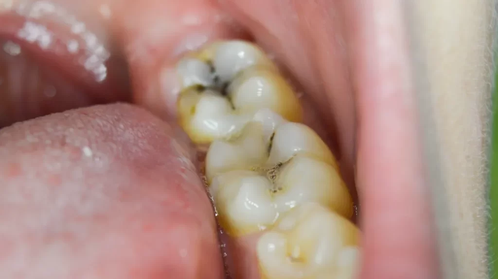 Is It Possible for Small Cavities to Heal on Their Own?