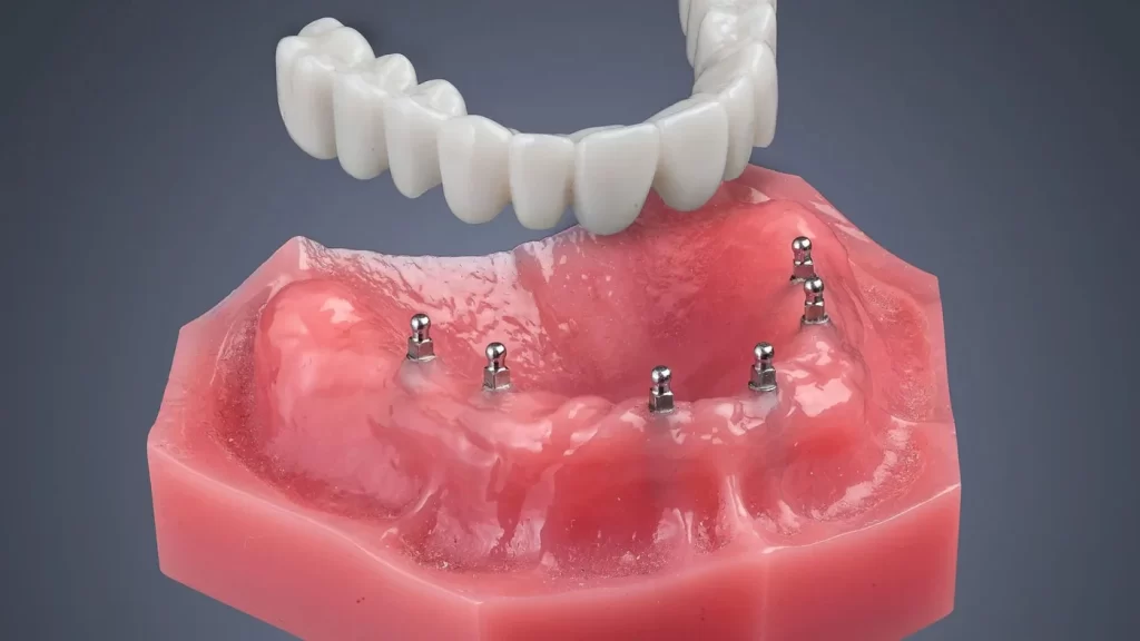 Understanding Mini Dental Implants