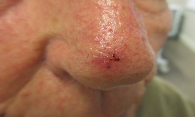 What Is Nose Basal Cell Carcinoma?